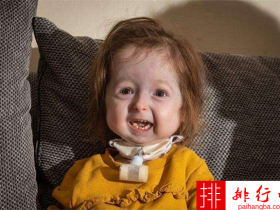 2岁女童面容衰老 患本杰明·巴顿病让人心疼