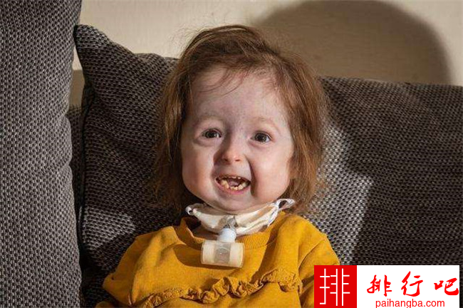 2岁女童面容衰老 患本杰明·巴顿病让人心疼